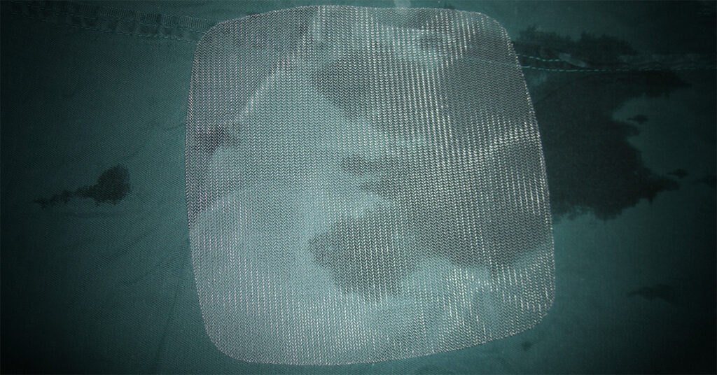 Hernia mesh made of polypropylene. By Doctoroftcm - Own work, CC BY-SA 3.0, https://commons.wikimedia.org/w/index.php?curid=12076157